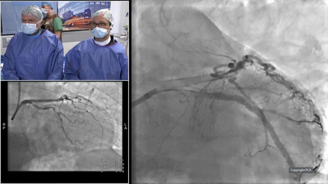 Management of complex non-culprit MVD after STEMI - LIVE case