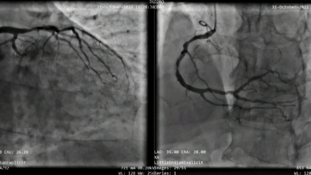 Management of perforation during PCI