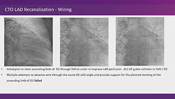 Difficult situations during CTO PCI