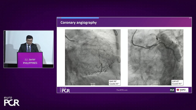 Myocardial infarction with cardiogenic shock - Challenging cases