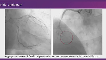 Novelty in percutaneous coronary interventions