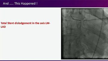 Percutaneous coronary interventions complications