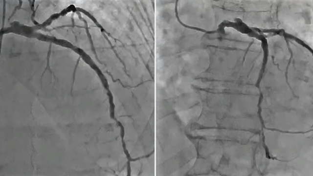 PCI for complex coronary lesions