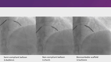 Percutaneous coronary intervention with bioresorbable scaffolds