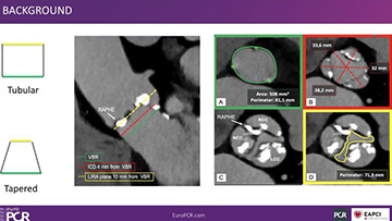 Interventional cardiology abstracts