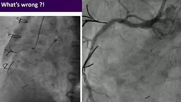Percutaneous coronary interventions