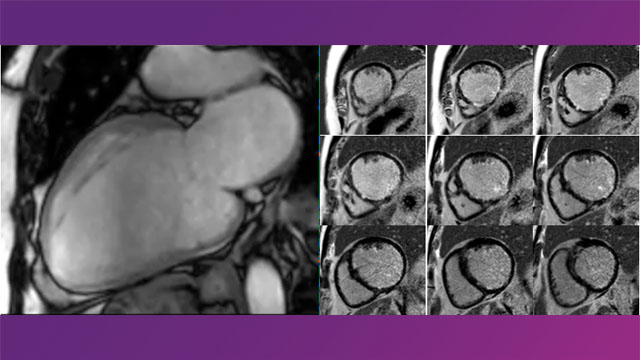 Revascularisation in patients with depressed left ventricular ejection fraction