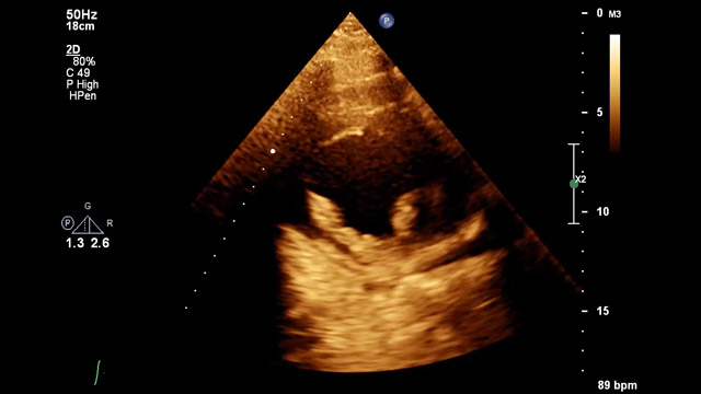 REVIVED: will this trial change my practice?