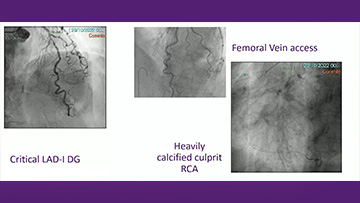 STEMI and calcifications bad association