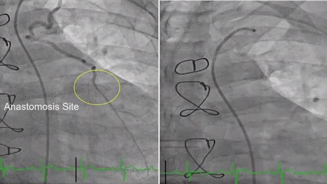 STEMI and surgery: how to treat
