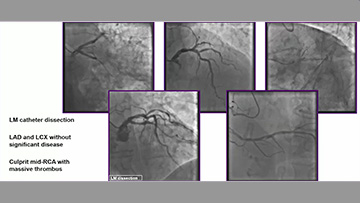STEMI and unusual thrombus