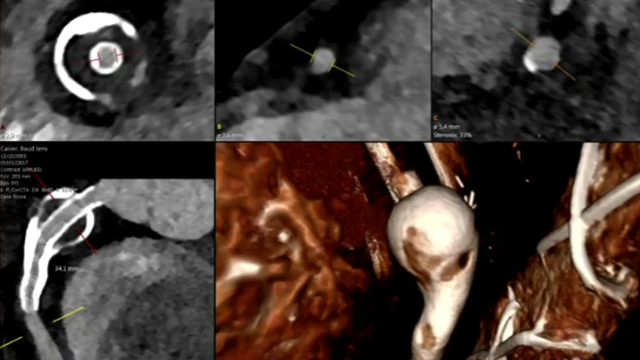 STEMI: the value of intra coronary imaging
