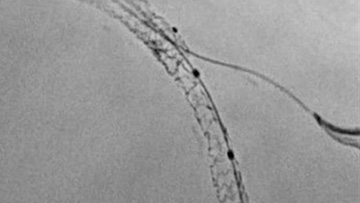 ST-Segment Elevation Myocardial Infarction: a stent problem