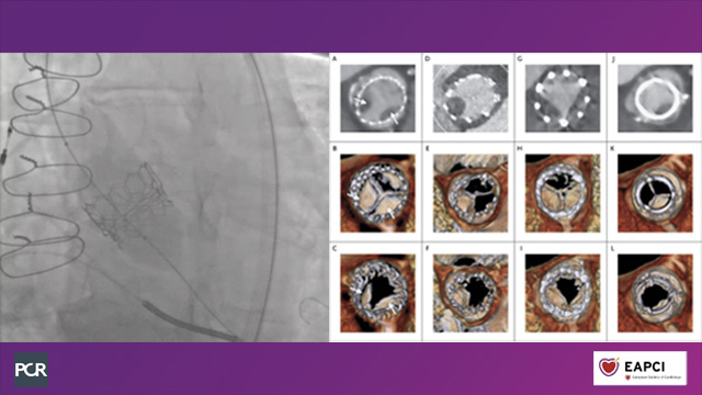 TAVI 1: durability, mismatch and challenging anatomy