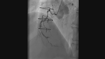Post-CABG CTO challenge