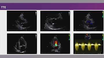 Transcatheter mitral valve therapies