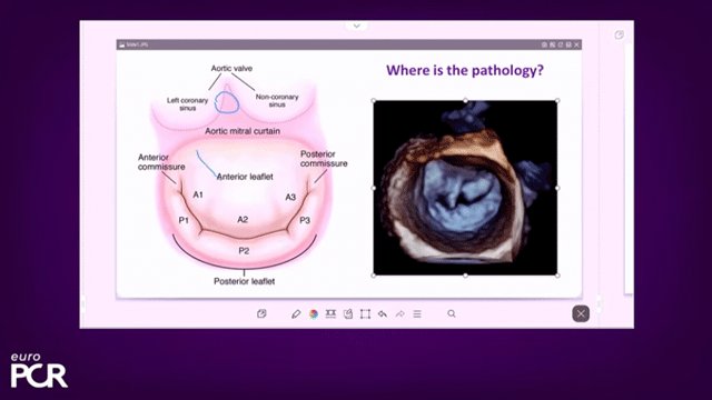 Treating diverse mitral regurgitation anatomies: the power of versatility