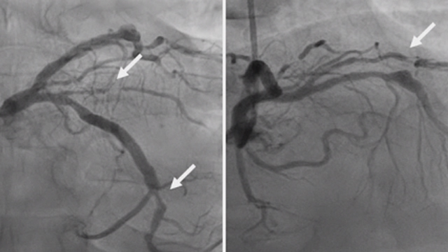 Treatment of calcified lesions