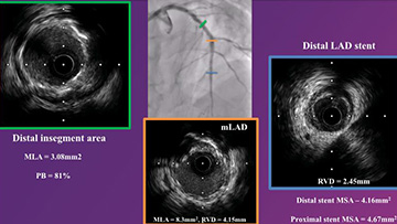 In-stent restenosis case
