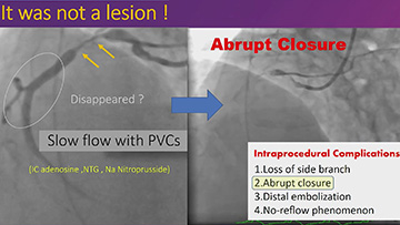 When dissection occurs during primary PCI