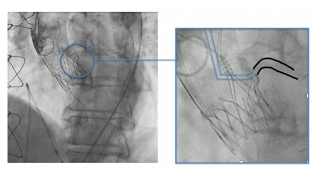 Which valve for which patient? - Part 1: simple anatomy
