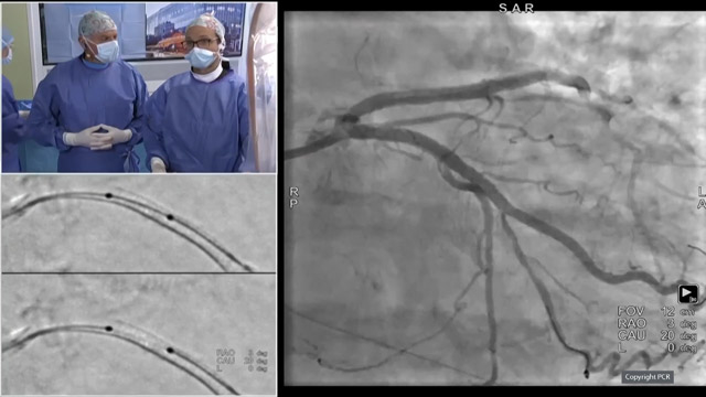 Complex PCI in high bleeding risk patients, the way forward!