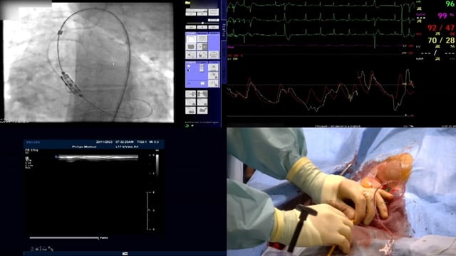 Essentials of lifetime management of TAVR patients using novel Myval THV
