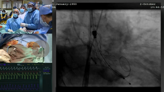 From access to annulus: overcoming challenging anatomies