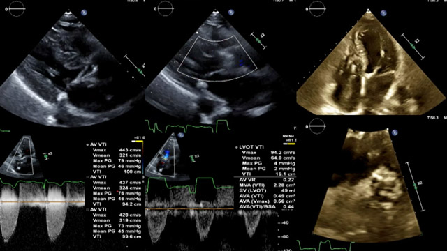 Newer generation self-expanding platform: technical optimisation for common clinical challenges