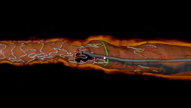 Next-generation complex PCI toolkit and novel balloon expandable Myval THV