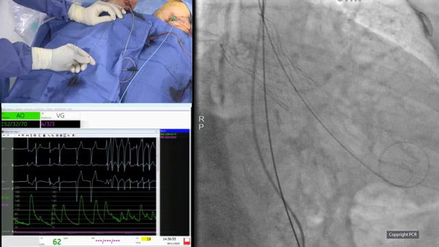 TAVI for bicuspid aortic stenosis patients - LIVE case