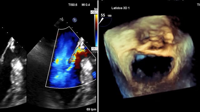 Multiple VHD: a diagnostic and clinical challenge