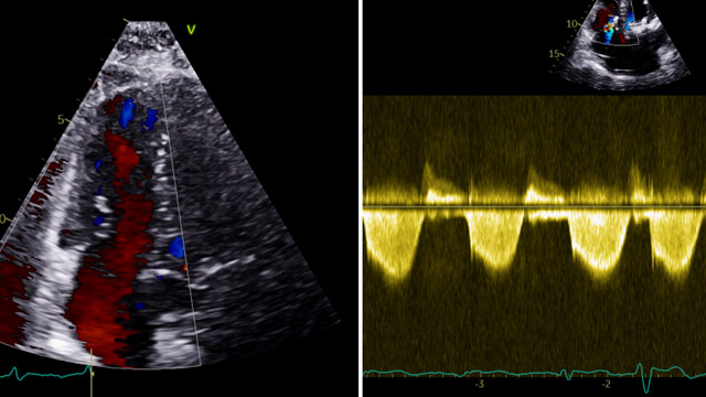 Transcatheter tricuspid valve interventions: outcomes