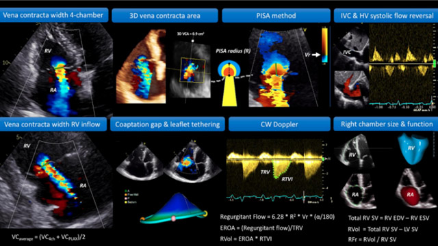 Transcatheter tricuspid valve interventions: procedural considerations