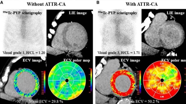 Where are we going? The symptomatic patient with moderate aortic stenosis