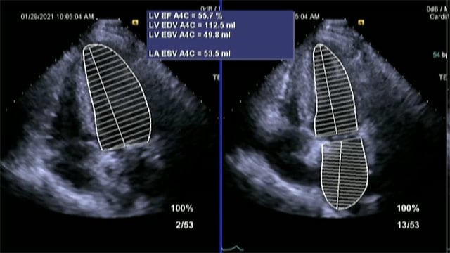 A problem and a solution: aortic regurgitation and the Trilogy TAVI valve