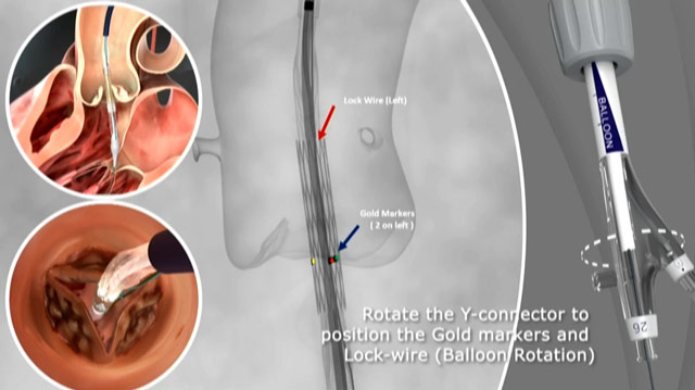 Addressing remaining issues after TAVI: what to expect from the new generation?