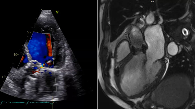 Aortic regurgitation - Part 3