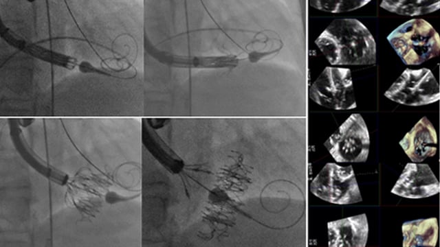 Complex tricuspid interventions