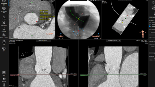 Contemporary surgical and transcatheter approaches for multivalve disease