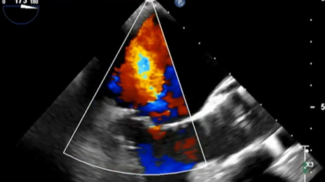Controversies in atrioventricular valves