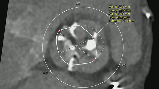 Defying complexity: achieving optimal TAVI procedural outcomes in challenging anatomies with the new Evolut FX