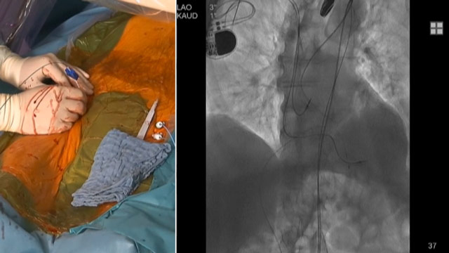 Essentials of lifetime management of TAVI patients