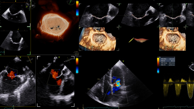 Interventions for multiple valve disease