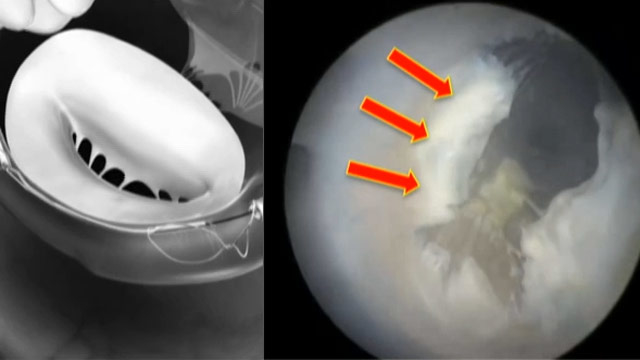 Is only fixing functional mitral regurgitation in heart failure patients enough?
