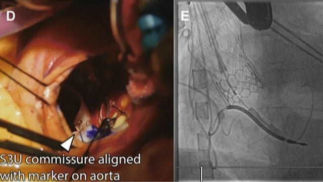 Key questions in aortic valve intervention - How to navigate valve sequencing in younger patients?