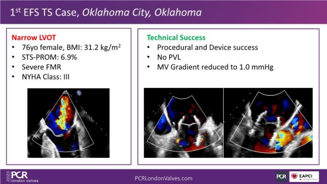 Mitral Late-Breaking Trials - PCR London Valves 2023