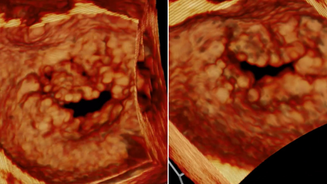 Mitral valve interventions in challenging clinical situations