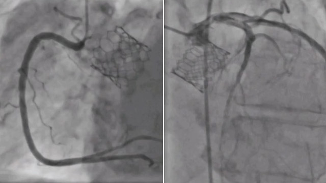 Planning and execution of re-do TAVI (TAV-in-TAV) procedures