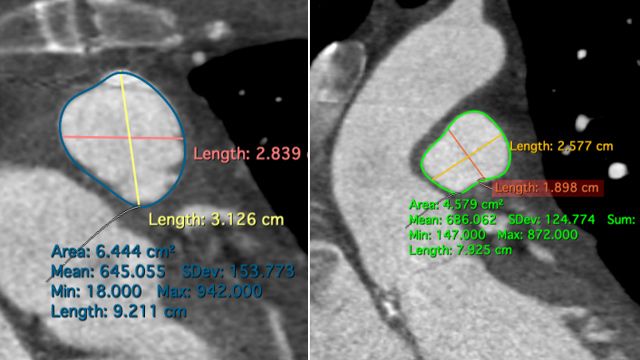 Pulmonary valve interventions